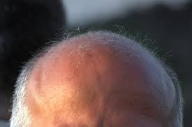 Rutin beavatkozás a greffe de cheveux
